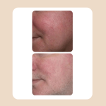 33. RosaceaTreatment