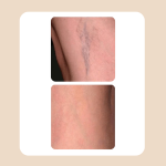 9.Vascular Laser