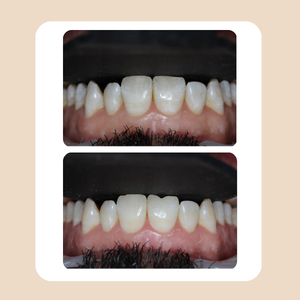 Full Mouth Reconstruction