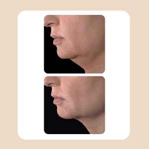 Skinexpert faceLift