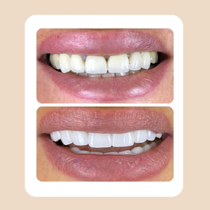 dental implants gallery 01