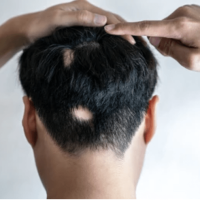 alopecia treatment in dubai