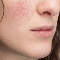 Atopic Dermatitis (Eczema) Treatment in Dubai