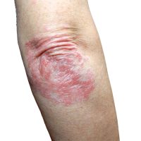 Psoriasis Treatment