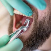 Tooth Extraction & Wisdom Tooth treatment in dubai