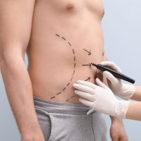 Tummy Tuck techinique in Skin Experts Polyclinic