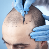 Hair Transplantation treatment clinic in dubai